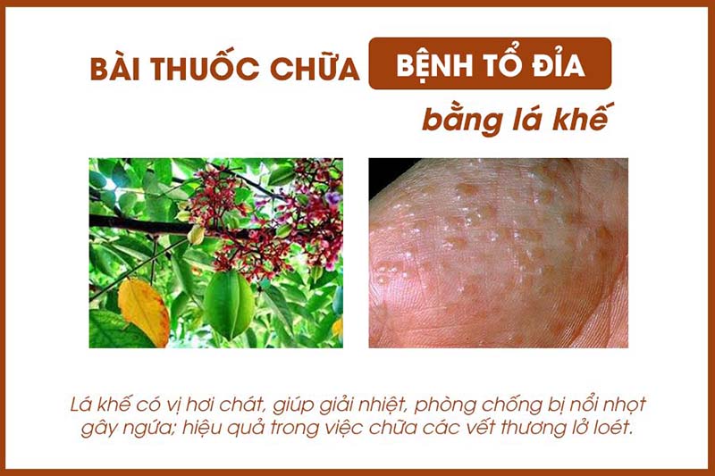 Mẹo chữa tổ đỉa tại nhà bằng lá khế được nhiều người áp dụng