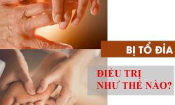 Điều trị bệnh tổ đỉa