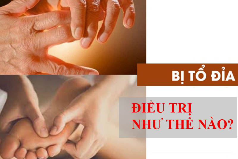 Điều trị bệnh tổ đỉa