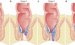 Các cấp độ bệnh trĩ