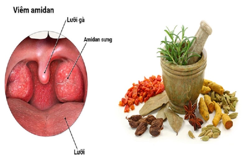 Người bệnh nên thử áp dụng các bài thuốc Đông y trị viêm amidan