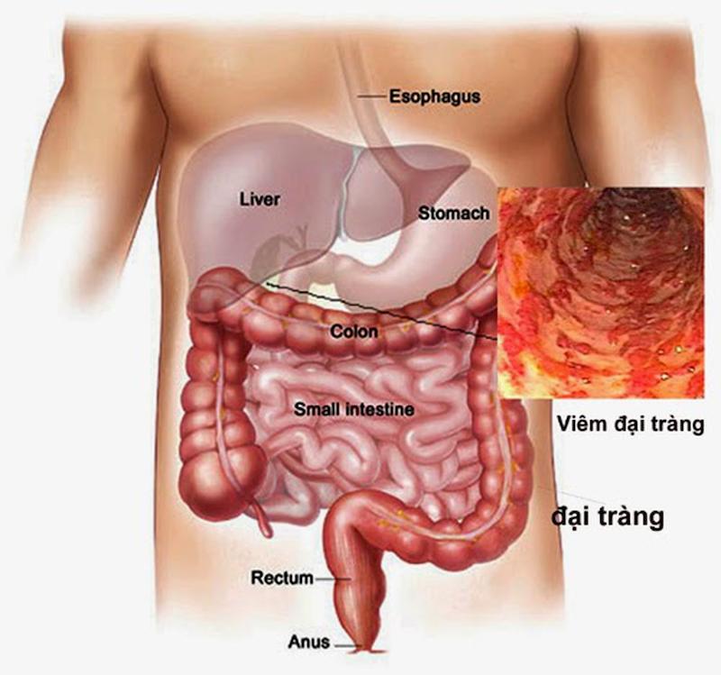 Viêm đại tràng là tình trạng bệnh gây ảnh hưởng rất lớn đến sức khỏe