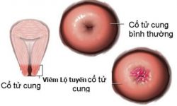 Viêm lộ tuyến cổ tử cung: Dấu hiệu, nguyên nhân và cách điều trị an toàn