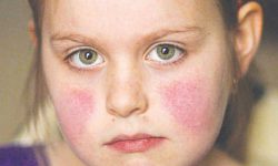 Lupus ban đỏ nếu không được điều trị có thể gây nhiều biến chứng nguy hiểm