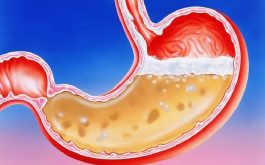 Cách chữa bệnh dư axit dạ dày hiệu quả cho mọi đối tượng