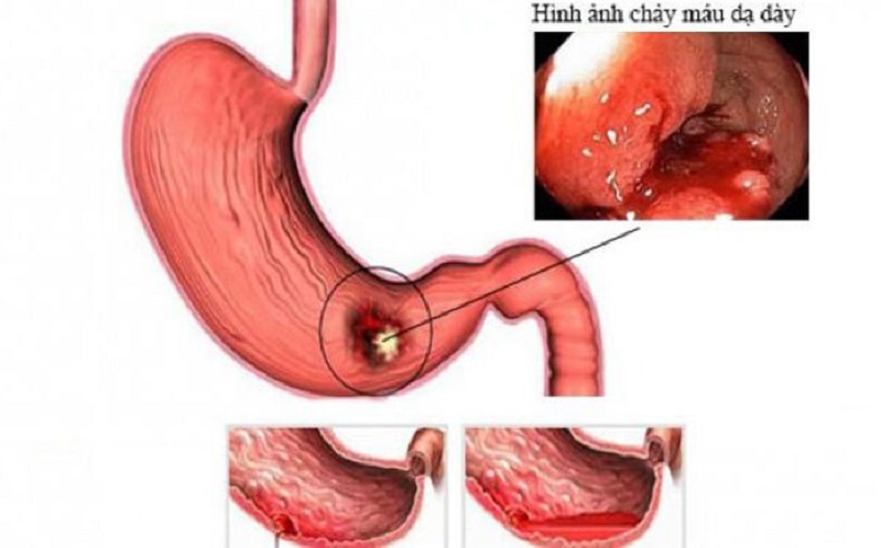 xuất huyết tiêu hóa dưới