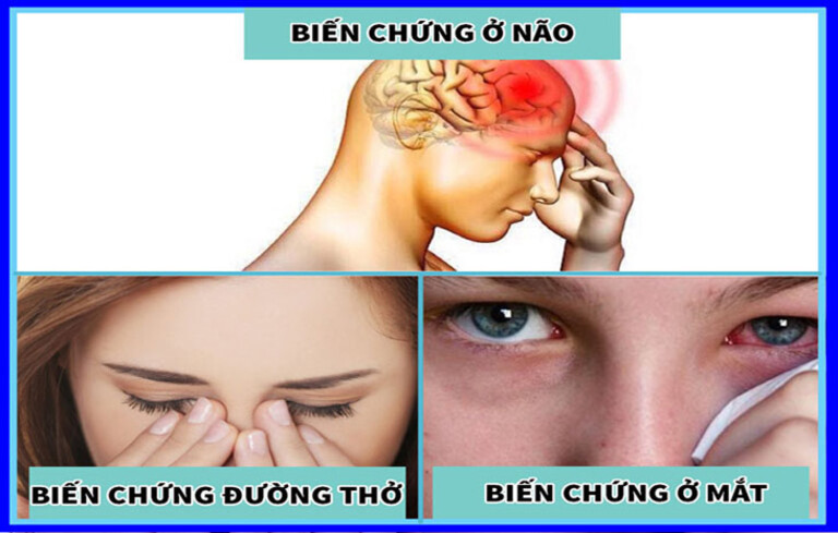 Bệnh viêm xoang có nguy hiểm không?