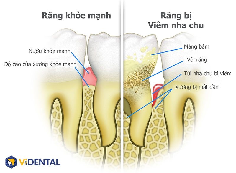 Viêm Nha Chu Mãn Tính: Nguyên Nhân, Dấu Hiệu Và Cách Trị Bệnh