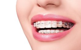 Các loại dây cung trong niềng răng có tác dụng tốt trong quá trình đưa răng về vị trí mong muốn.