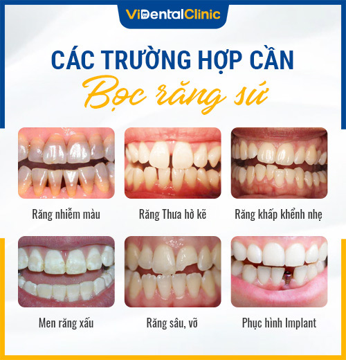 Bọc răng sứ có đau không? chi phí, quy trình và tuổi thọ răng sứ - Tin tức sự kiện - Sở Y tế tỉnh Thái Nguyên