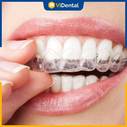 Công nghệ niềng răng Invisalign được nhiều người áp dụng khi đến với ViDental