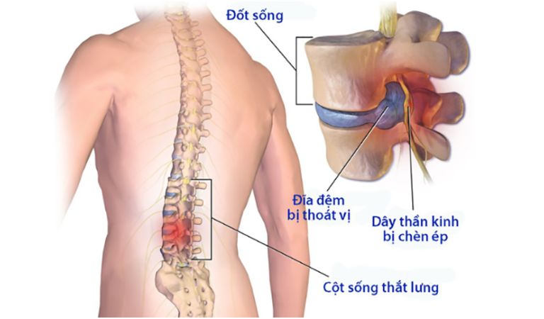 đau nhức xương khớp tê bì chân tay