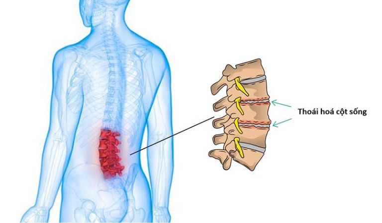 Hình ảnh thoái hóa cột sống