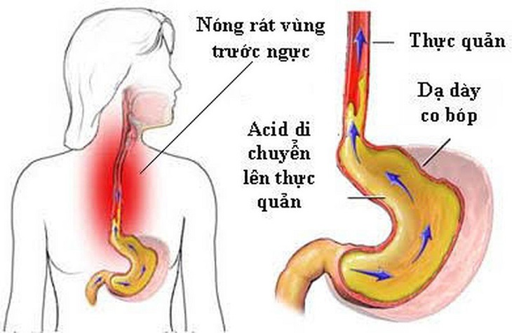 viêm hang vị trào ngược thực quản