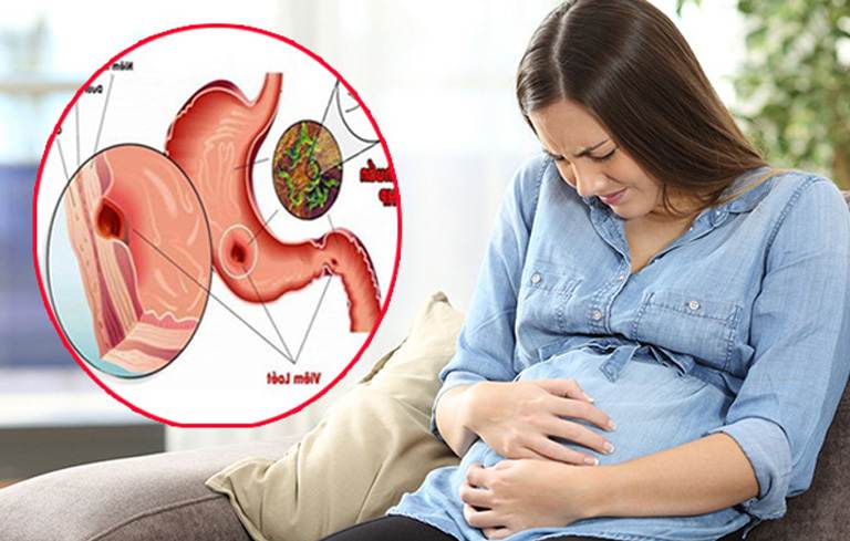 Có những biện pháp phòng ngừa đau dạ dày khi mang thai mà phụ nữ nên áp dụng?