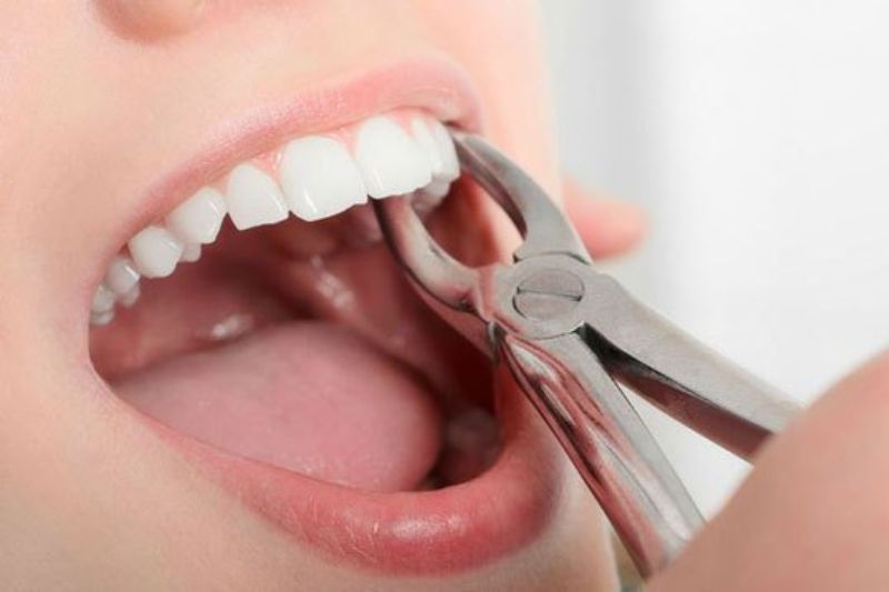 Nhổ răng gây ra thoái hóa khớp thái dương hàm