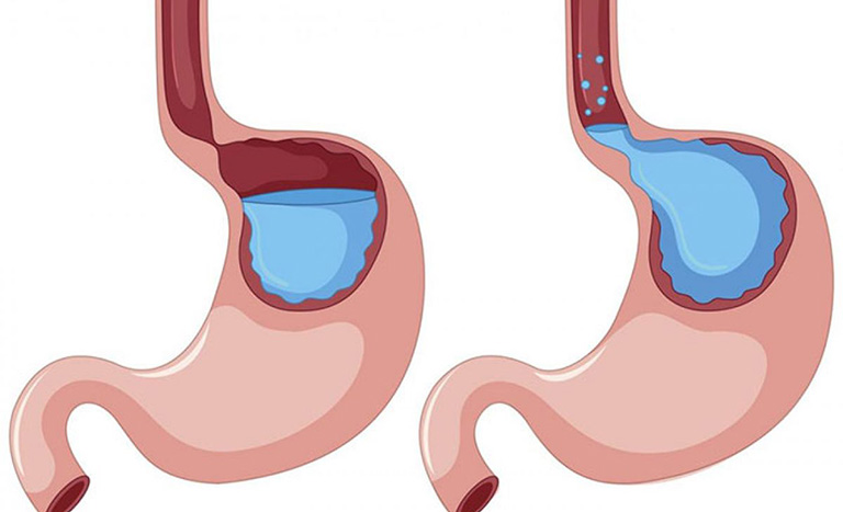 viêm hang vị dạ dày trào ngược dịch mật