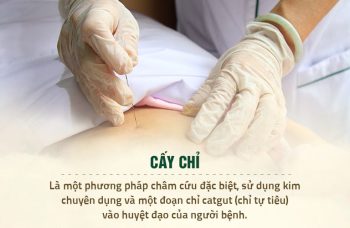 Cấy chỉ bao lâu thì có tác dụng