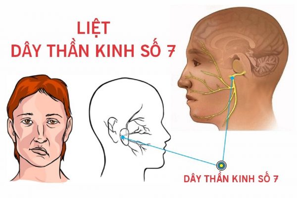 Cách phòng tránh liệt dây thần kinh số 7