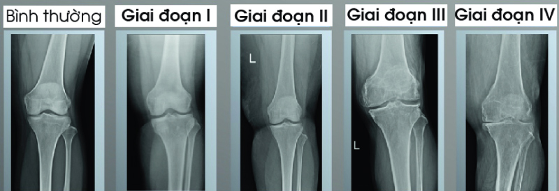 4-giai-doan-thoai-hoa-khop-goi