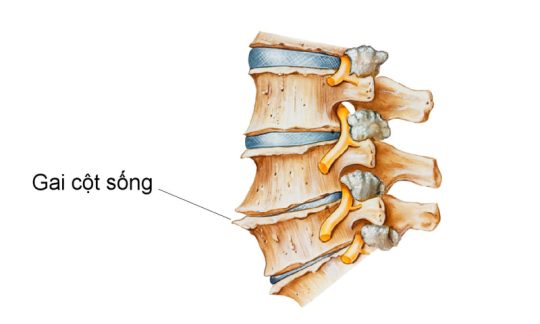 Gai cột sống là gì?