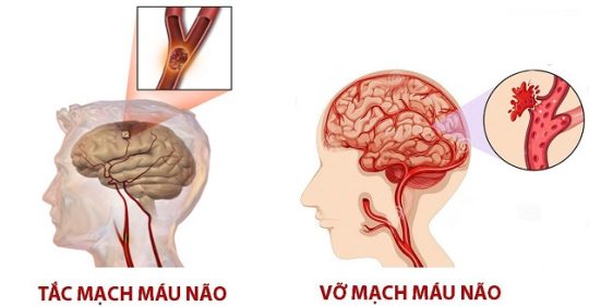 Châm cứu được ứng dụng trong điều trị các bệnh lý tai biến 