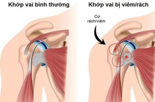 Bệnh viêm quanh khớp vai