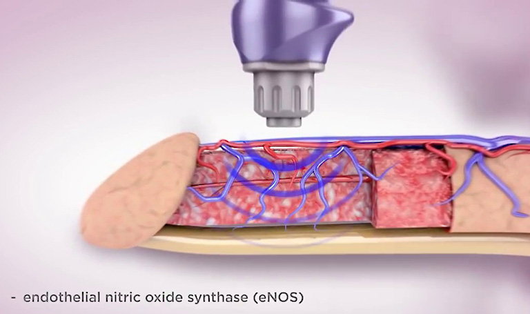 Quy trình điều trị rối loạn cương dương bằng sóng xung kích