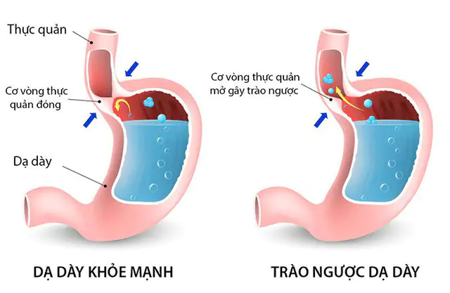 trao-nguoc-da-day-2