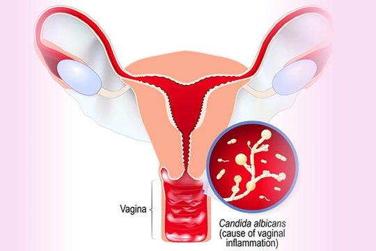 Tầm quan trọng của thuốc chữa trị viêm âm đạo