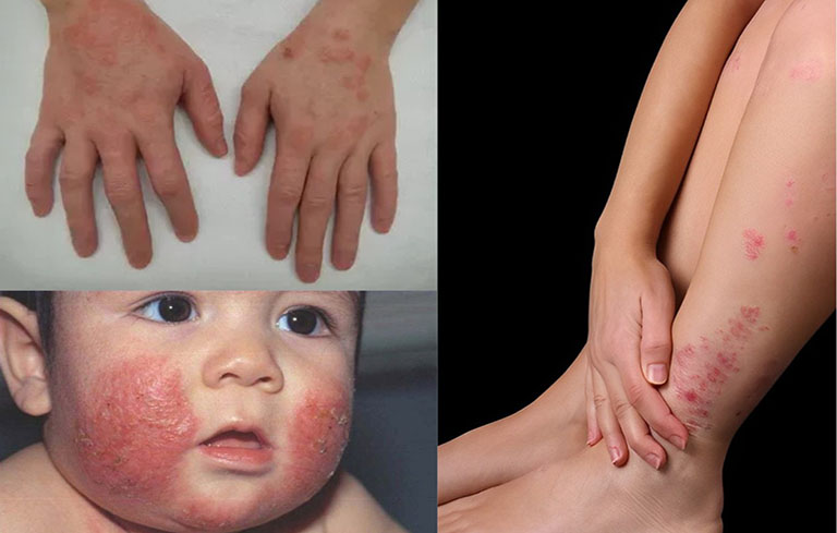 Trẻ nhỏ cũng dễ mắc chàm eczema