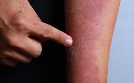 Cần phân tích tế bào da để xác định thể bệnh chàm eczema