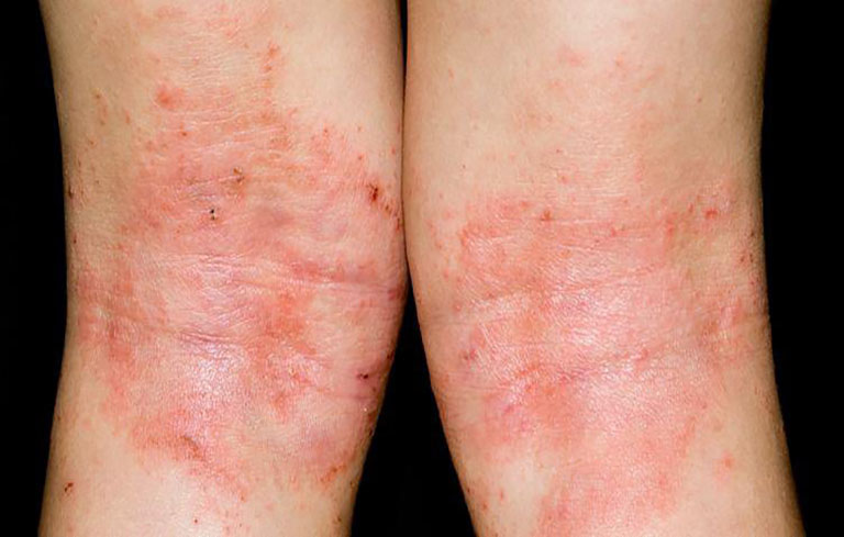 Eczema là dấu hiệu của bệnh chàm