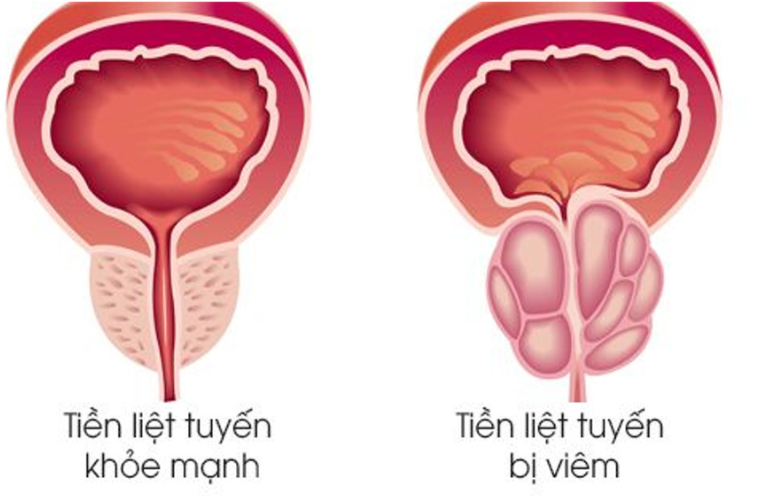 Viêm tuyến tiền liệt là bệnh viêm nhiễm nam khoa khá phổ biến